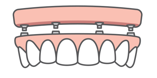 Full-arch replacement icon, one of our dental implant solutions