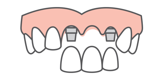 Multiple teeth replacement icon, one of our dental implant solutions