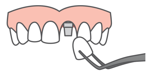 Single tooth replacement icon, one of our dental implant solutions.