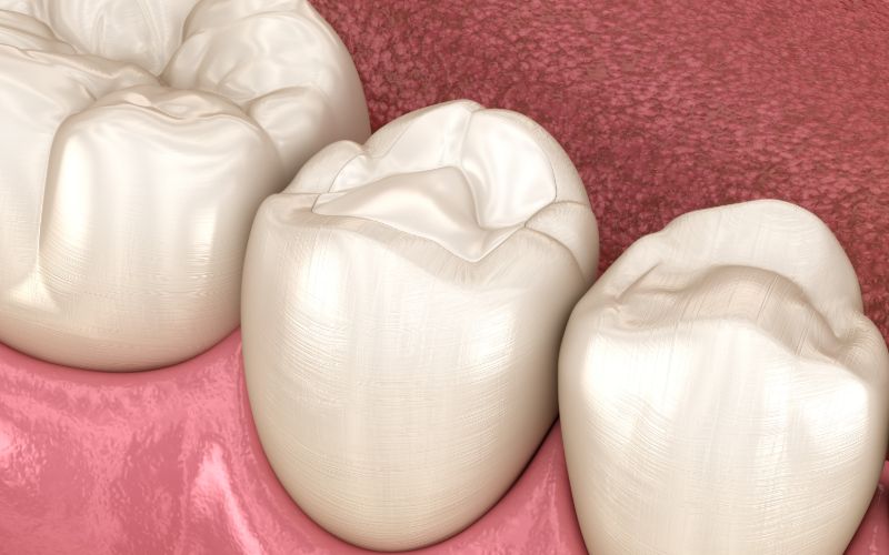 Tooth colored fillings