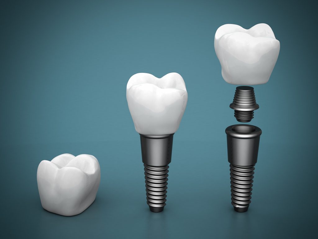 how a dental implant works