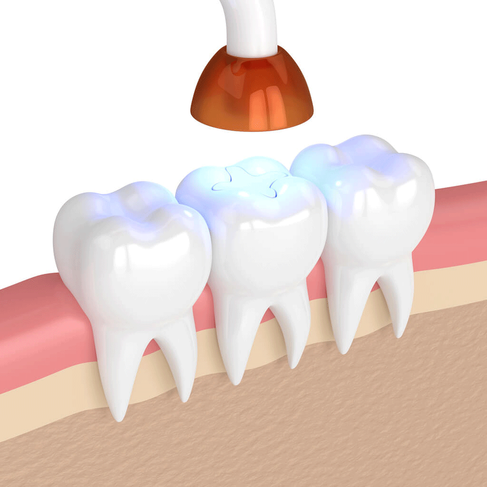 3D illustration of a dental curing light applied to a molar with a freshly placed filling, demonstrating a tooth restoration procedure, with light emitting onto the tooth's surface, set against a neutral background.
